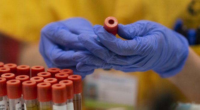 Números mostram que Brasil ainda faz ‘brutalmente’ menos testes para coronavírus do que deveria; ‘estamos no escuro’, diz especialista